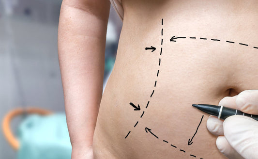 Abdominal Marking