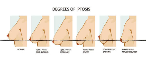 Breast Lift (Mastopexy)