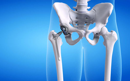 Hip Replacement